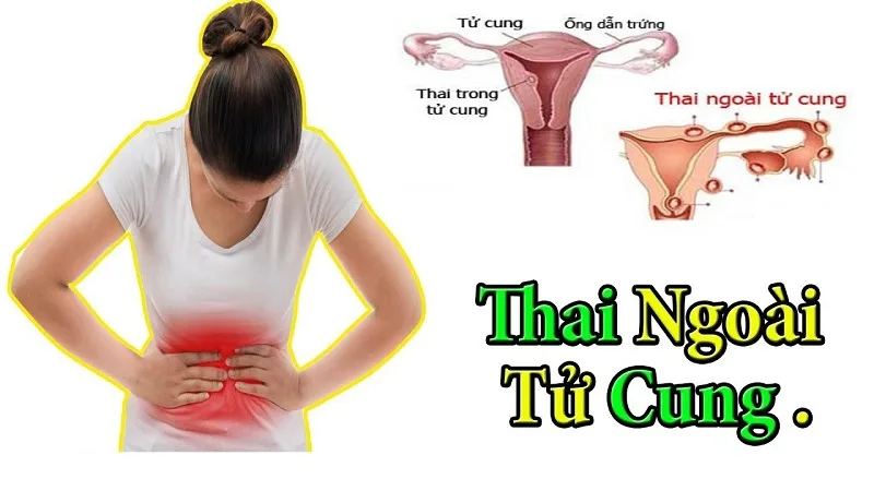 Thai Ngoài Tử Cung: Mức Độ Nguy Hiểm và Những Điều Cần Biết